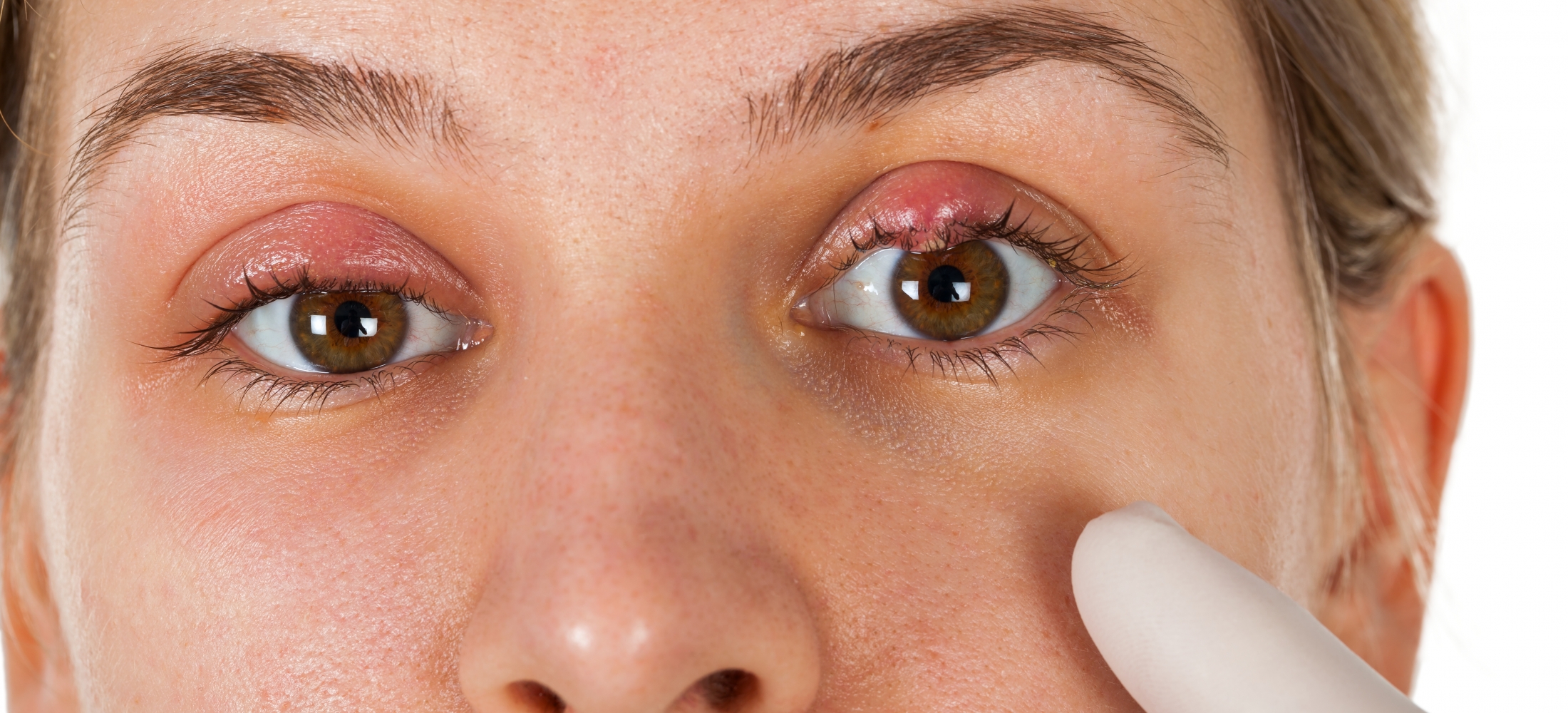 Todo lo que necesitas saber sobre los orzuelos y su cuidado Óptica